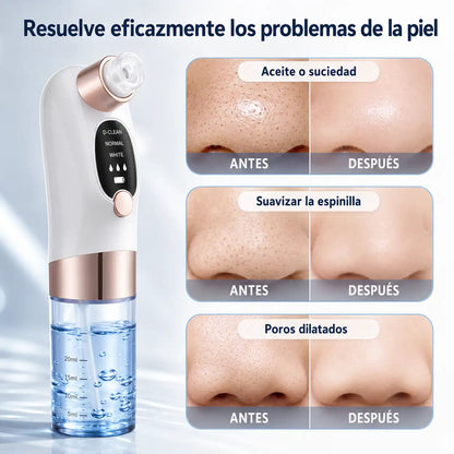 Micro Bubble Pro: Elimina Puntos Negros y Espinillas en minutos ✨